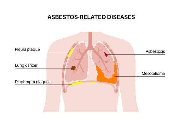 Asbestos- Diseases - Total Asbestos