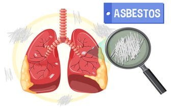 Asbestosis symptoms 1